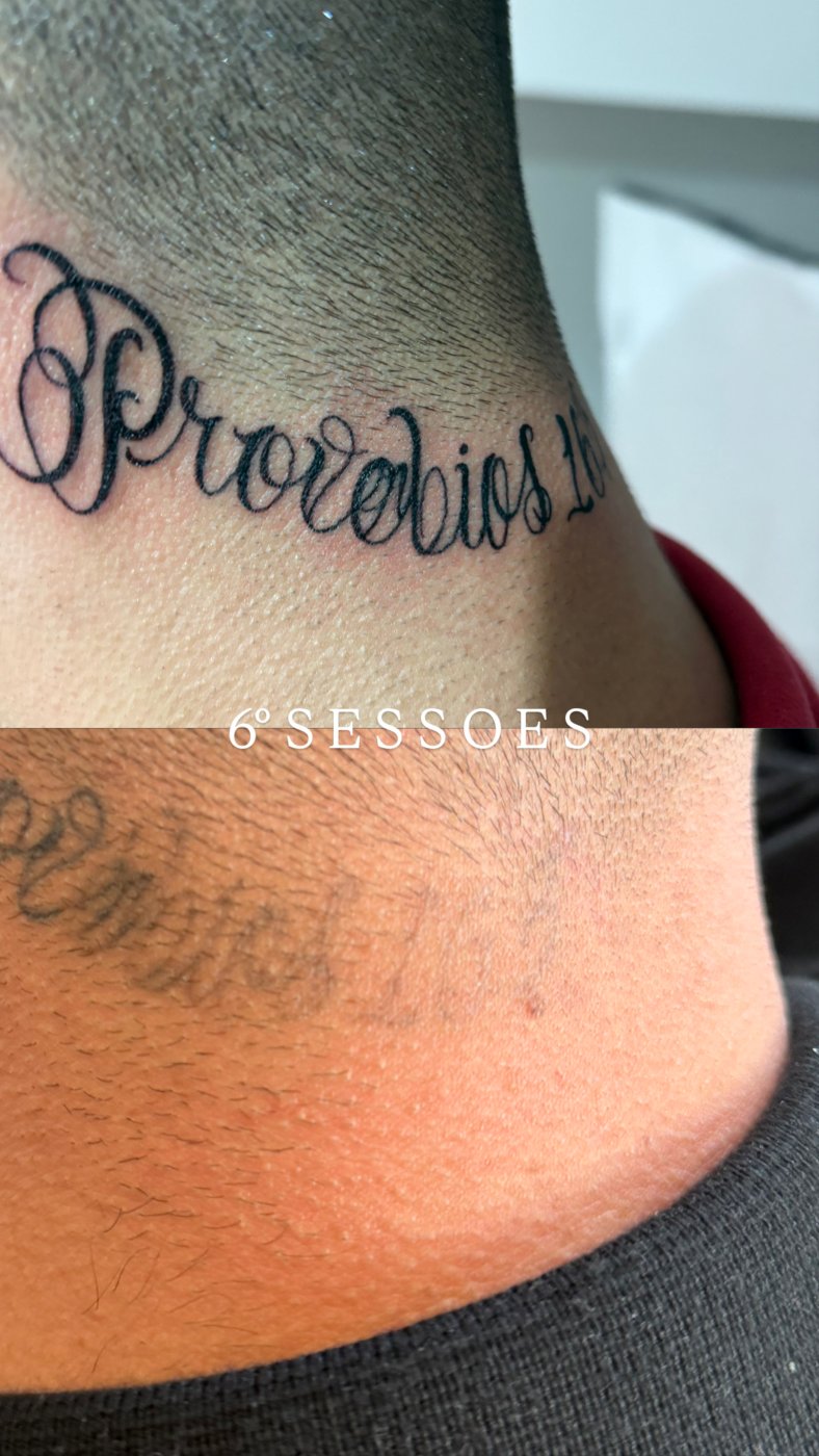Antes e depois de remoção de tatuagem a laser em Araçatuba — caso 2