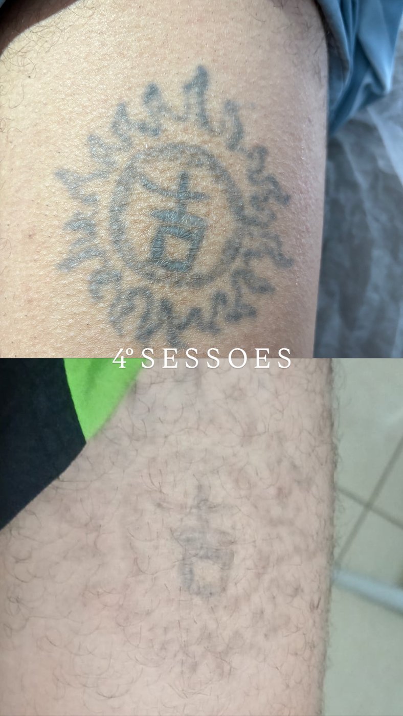 Antes e depois de remoção de tatuagem a laser em Araçatuba — caso 3