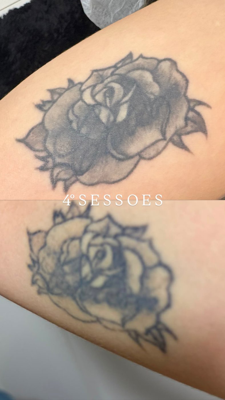 Antes e depois de remoção de tatuagem a laser em Araçatuba — caso 4