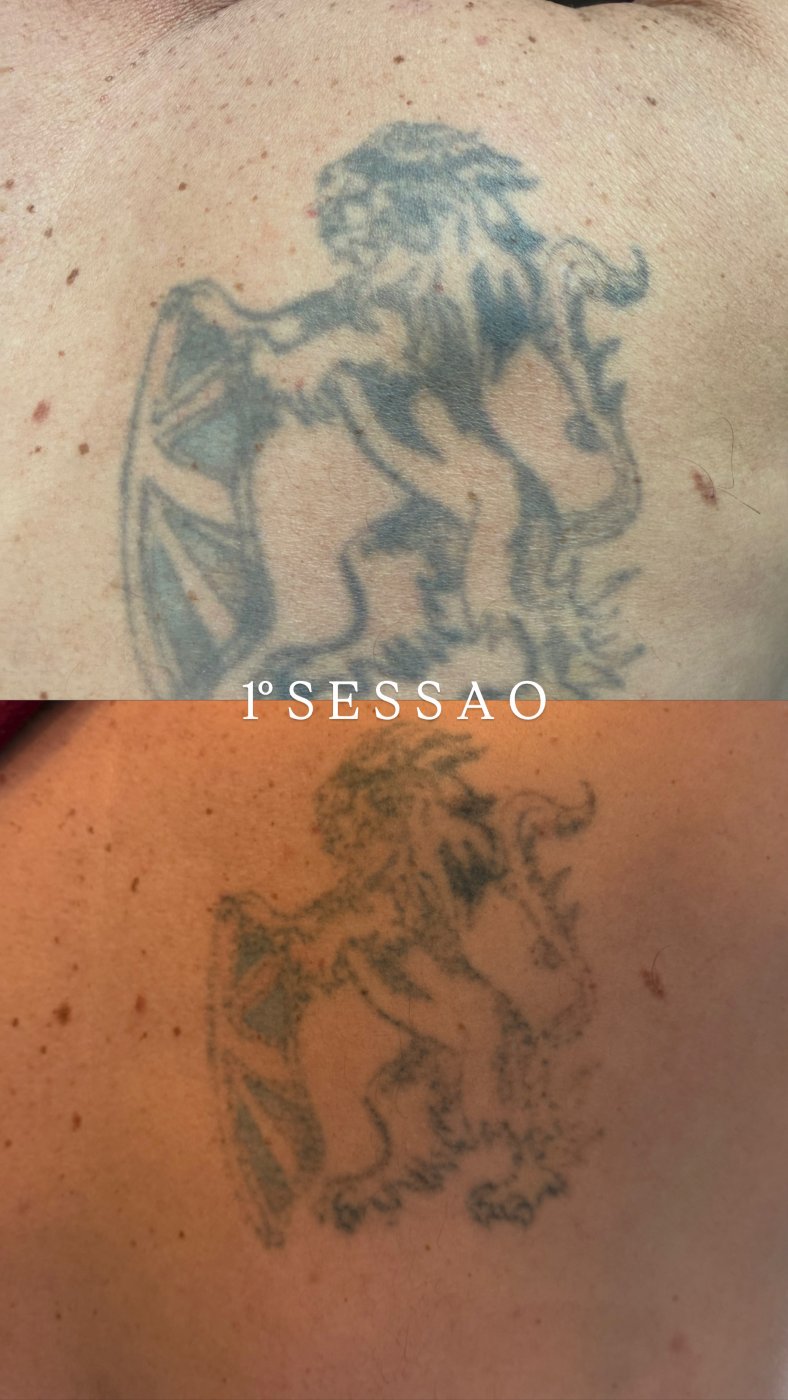 Antes e depois de remoção de tatuagem a laser em Araçatuba — caso 5
