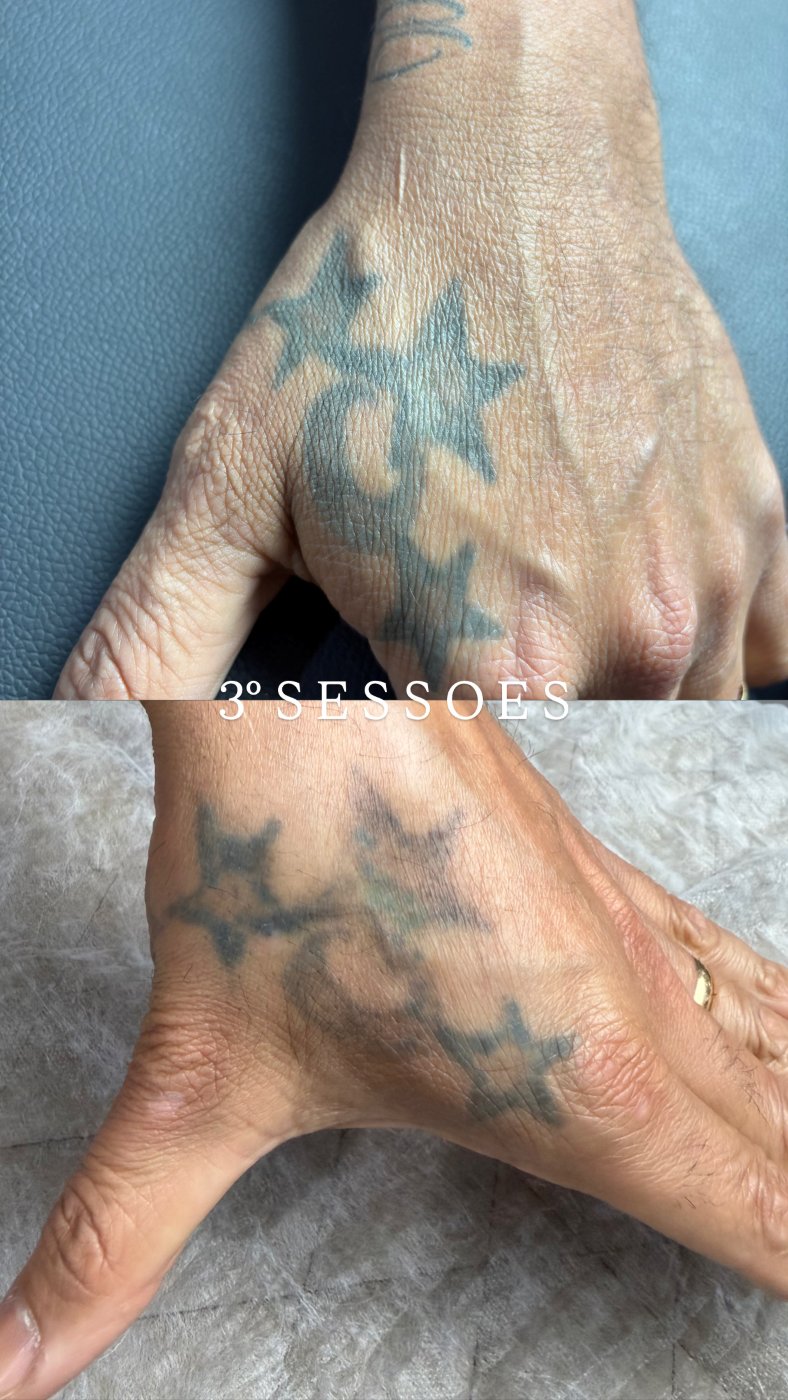 Antes e depois de remoção de tatuagem a laser em Araçatuba — caso 6